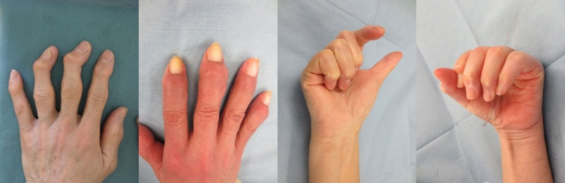 手指の痛みやしびれ……エクオールに期待される役割とは?