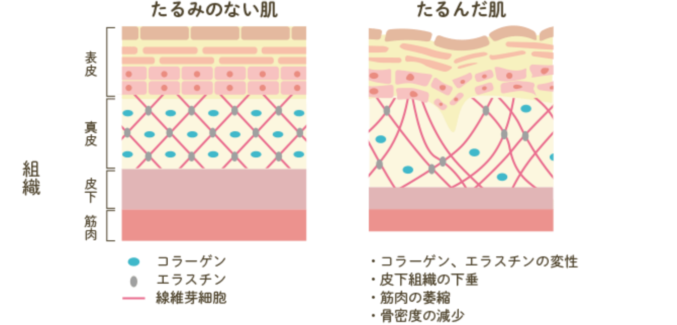 たるんだ肌は、コラーゲン繊維やエラスチン線維の変性による機能低下が起こっている。