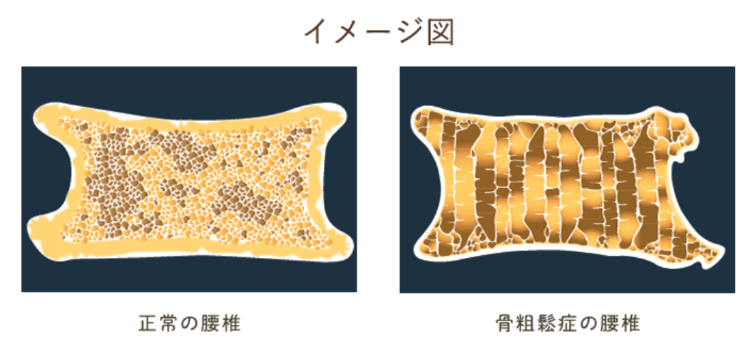 正常の腰椎と骨粗鬆症の腰椎