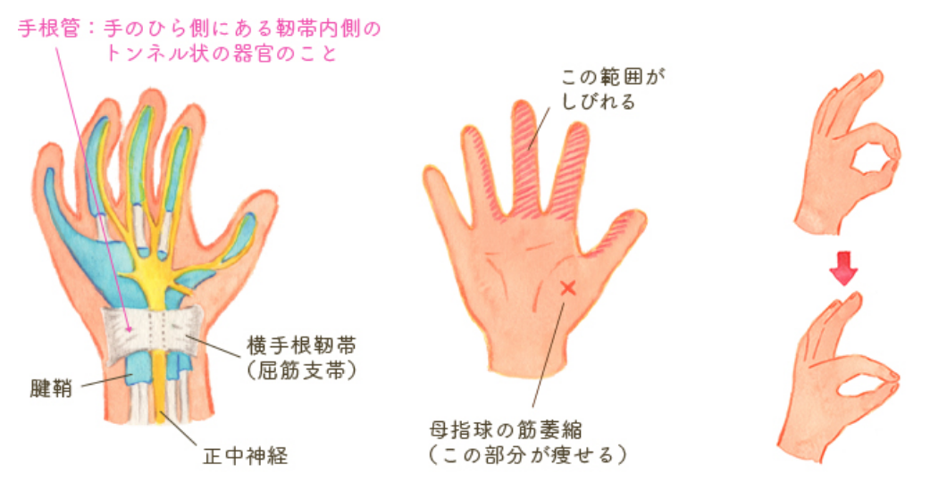 左図：手根管とは、手のひらにある靱帯内側のトンネル状の器官のことです。中図：親指から薬指の親指側半分までのどこかにしびれ、痛みが生じます。右図：親指と人差し指でマル（OKサイン）がつくりにくくなる症状がでます。