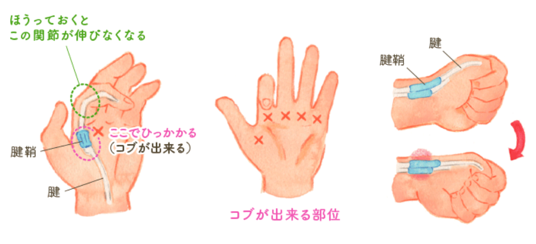 左、中：バネ指説明図。右図：ドケルバン病説明図