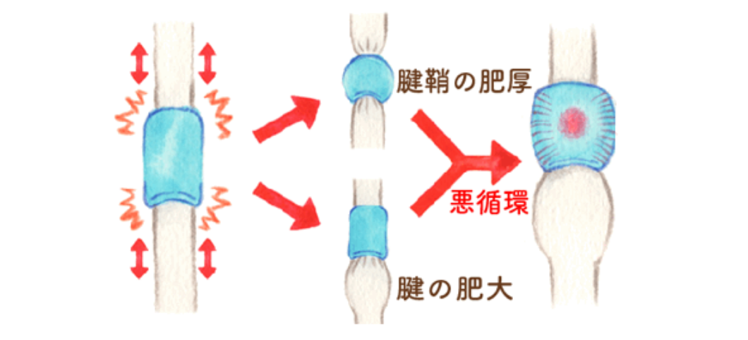 腱鞘炎（バネ指、ドケルバン病）が起こる原因は、腱鞘の肥厚や、腱の肥大がおこり痛みや腫れが強くなります