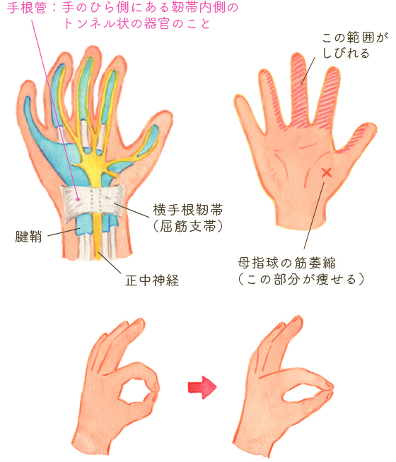 手根管症候群 手指の痛み しびれ 変形 更年期障害 更年期の悩み